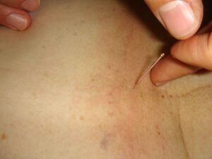 eine Hand setzt eine Akupunkturnadel in die Haut eines Patienten